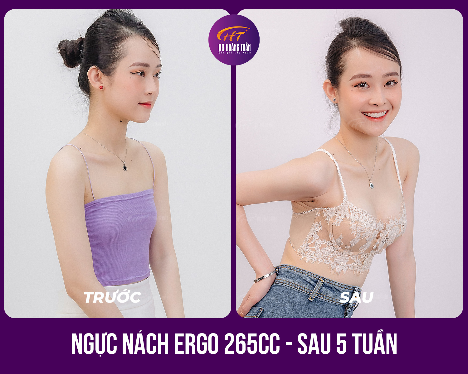 Kết quả nâng ngực đường nách - Dr Hoàng Tuấn